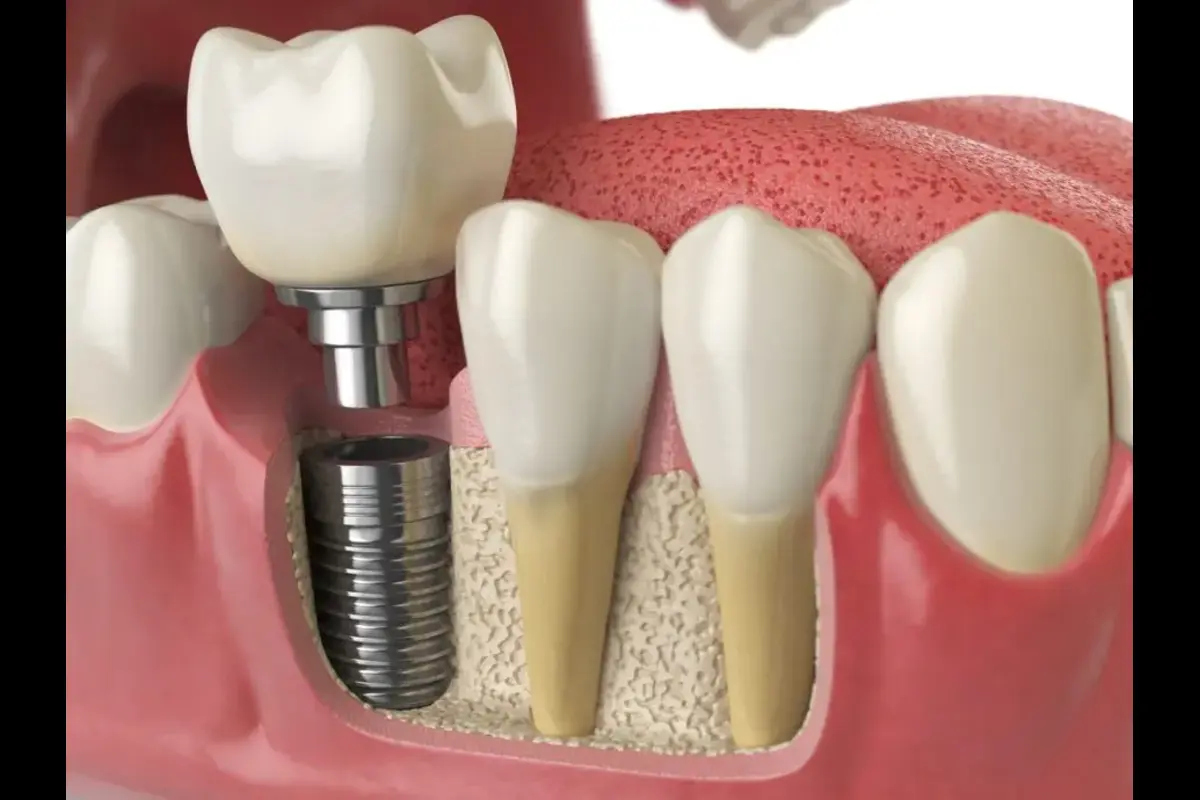 Dental Implants